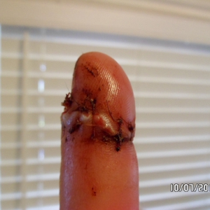 The damage to my finger!